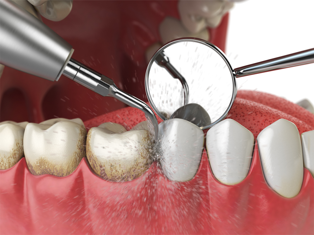 Dental Check-ups & Professional Cleaning